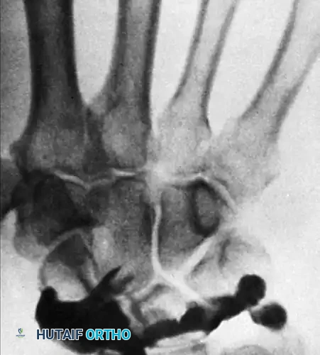 FIGURE 69-13 B, End of contrast injection, at point of slight patient discomfort; contrast material is confined to radiocarpal joint.