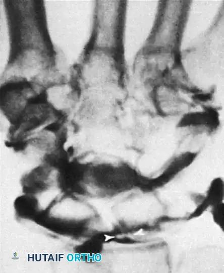 FIGURE 69-13 D, On followup overhead view, contrast material fills midcarpal joints, including scapholunate joint from its distal aspect, making it difficult to see whether scapholunate or lunotriquetral ligament is torn. Small defect (arrowheads) between contrast material in scapholunate space and radiocarpal space indicates intact scapholunate ligament.