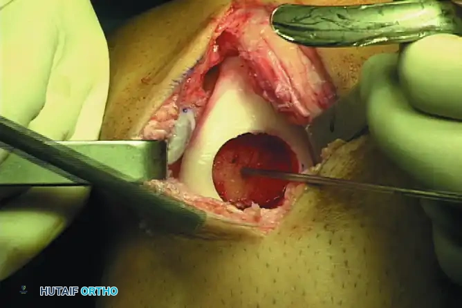 ARTICULAR CARTILAGE INJURIES Surgical Diagram