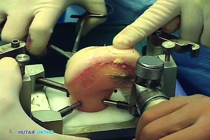 ARTICULAR CARTILAGE INJURIES Surgical Diagram