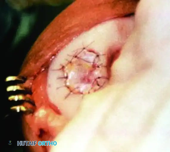 ARTICULAR CARTILAGE INJURIES Surgical Diagram