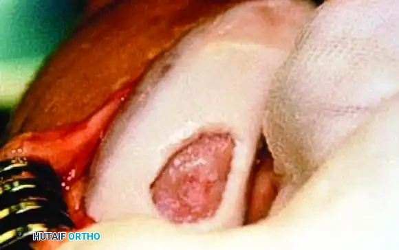 ARTICULAR CARTILAGE INJURIES Surgical Diagram