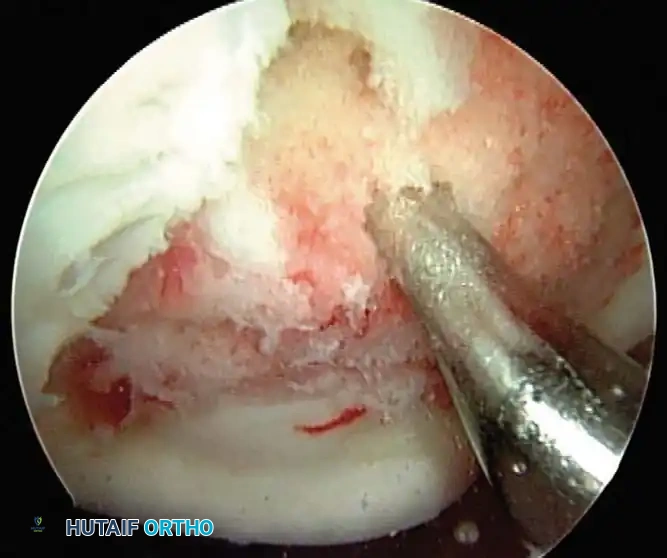 Operative Management of Articular Cartilage Injuries
