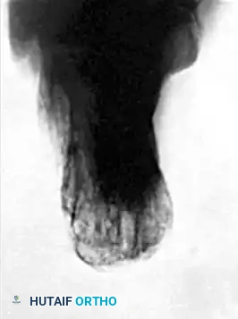 AXIAL FIXATION OF CALCANEAL FRACTURE Surgical Diagram
