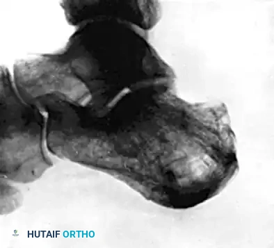 AXIAL FIXATION OF CALCANEAL FRACTURE Surgical Diagram
