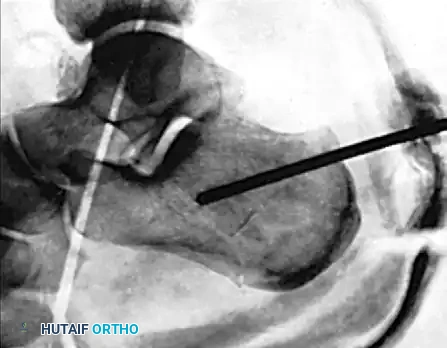 AXIAL FIXATION OF CALCANEAL FRACTURE Surgical Diagram