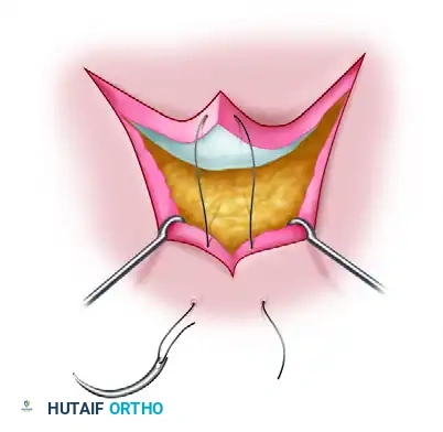 Apical stitch diagram 1