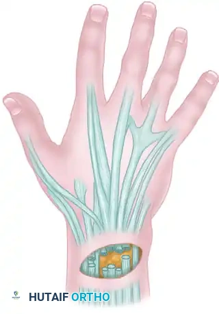 Skin closed by sufficient number of sutures placed more deeply