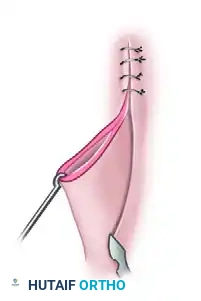 Dog ear excision step A
