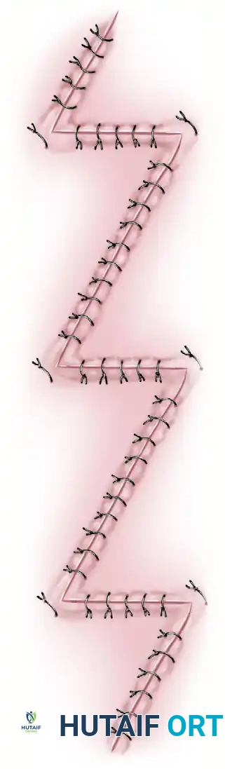 Multiple Z-plasty diagram 2