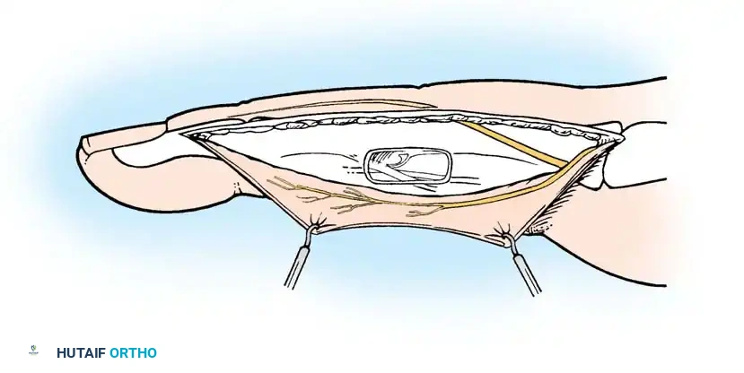 Fig. 61-16 Midlateral approach especially to expose fl exor tendon sheath.