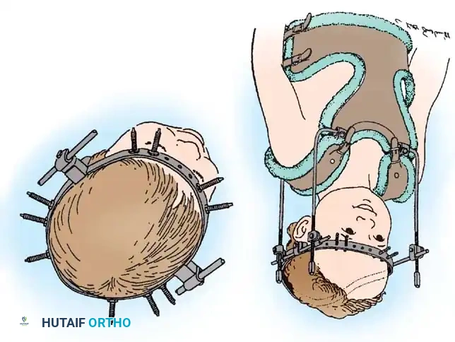 BASILAR IMPRESSION Surgical Diagram