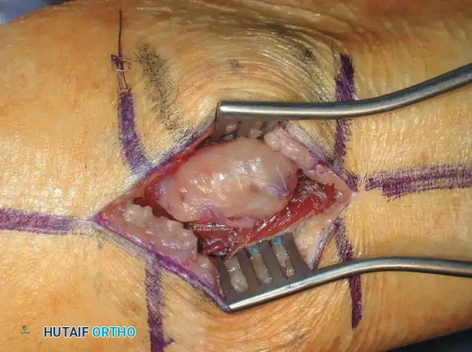 BENIGN TUMORS AND TUMOR-LIKE LESIONS Surgical Diagram