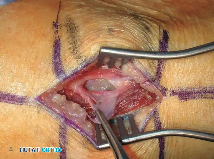 BENIGN TUMORS AND TUMOR-LIKE LESIONS Surgical Diagram