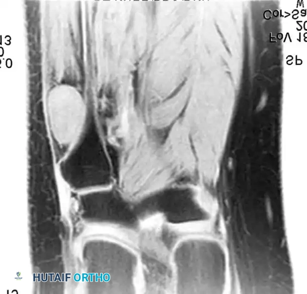 BENIGN TUMORS AND TUMOR-LIKE LESIONS Surgical Diagram