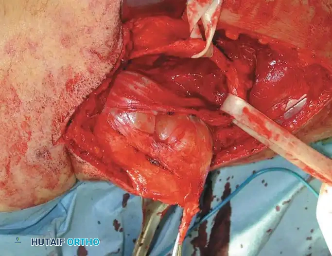 BENIGN TUMORS AND TUMOR-LIKE LESIONS Surgical Diagram