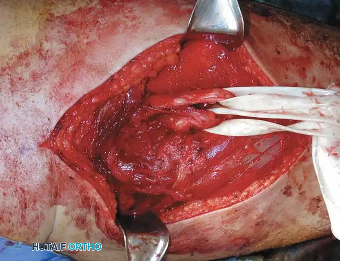 BENIGN TUMORS AND TUMOR-LIKE LESIONS Surgical Diagram