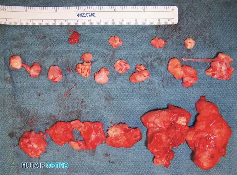 BENIGN TUMORS AND TUMOR-LIKE LESIONS Surgical Diagram
