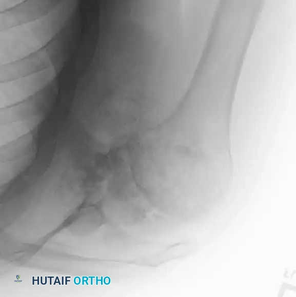 BENIGN TUMORS AND TUMOR-LIKE LESIONS Surgical Diagram