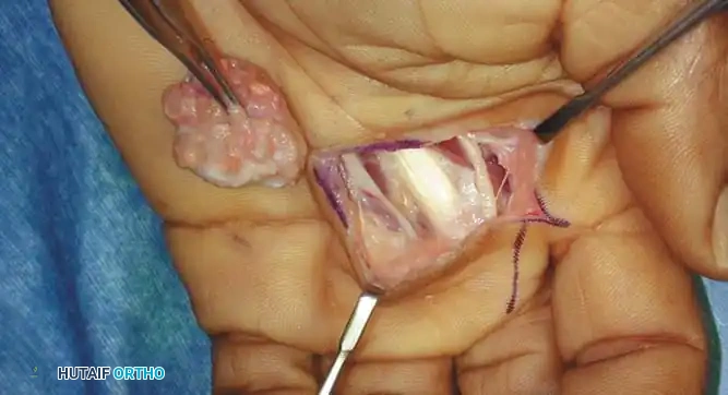 BENIGN TUMORS AND TUMOR-LIKE LESIONS Surgical Diagram