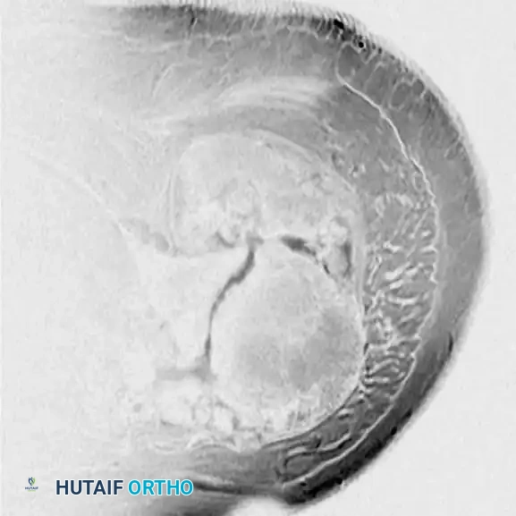 BENIGN TUMORS AND TUMOR-LIKE LESIONS Surgical Diagram