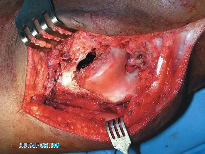 BENIGN TUMORS AND TUMOR-LIKE LESIONS Surgical Diagram