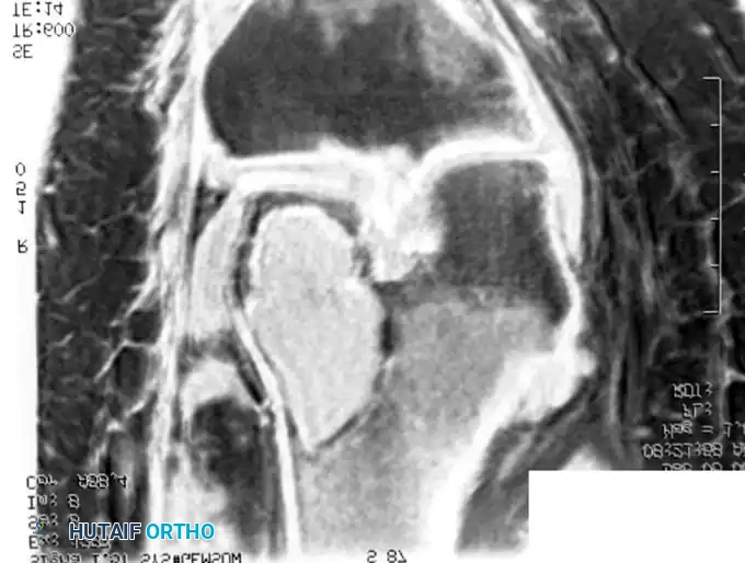 BENIGN TUMORS AND TUMOR-LIKE LESIONS Surgical Diagram