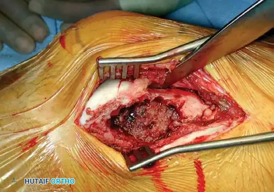 Benign/Aggressive Tumors of Bone Surgical Diagram