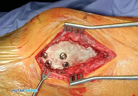 Benign/Aggressive Tumors of Bone Surgical Diagram