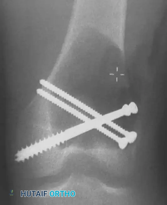Benign/Aggressive Tumors of Bone Surgical Diagram