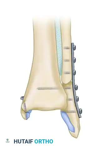 BIMALLEOLAR FRACTURE Surgical Diagram