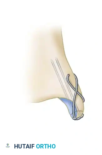 BIMALLEOLAR FRACTURE Surgical Diagram