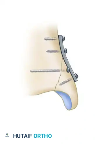 BIMALLEOLAR FRACTURE Surgical Diagram