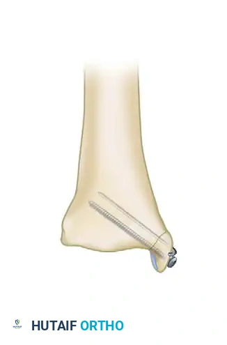 BIMALLEOLAR FRACTURE Surgical Diagram
