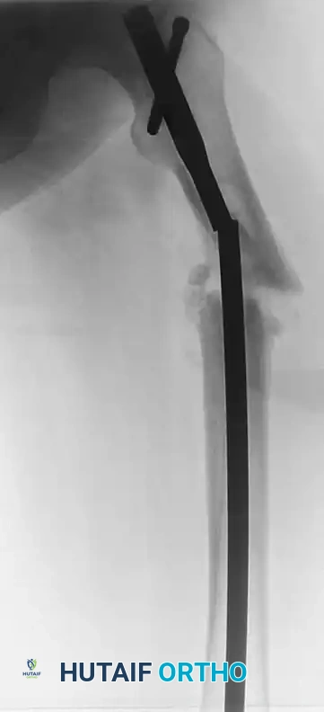 Biomechanical Construct Complications in Orthopaedic Trauma