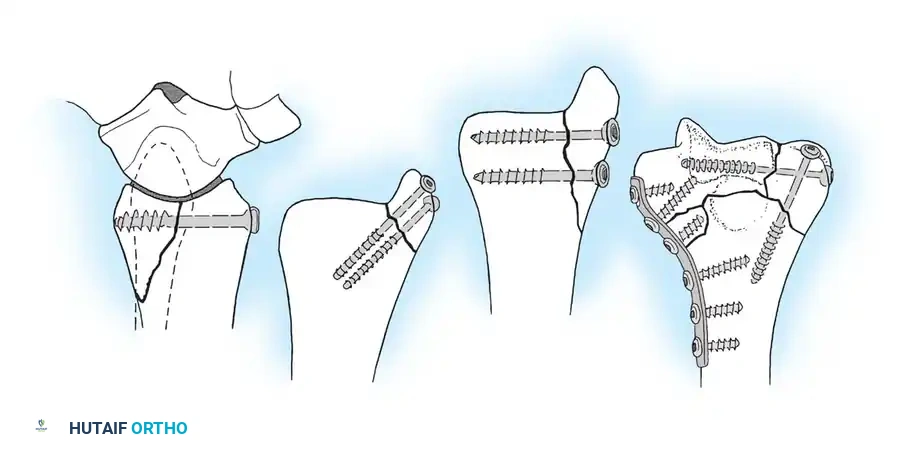 Articular Screw Fixation