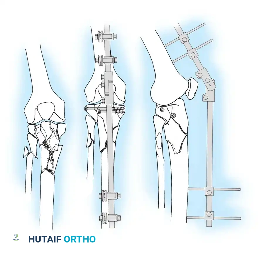Fig. 50-21 Examples of cancellous and cortical screws for fracture fi xation.