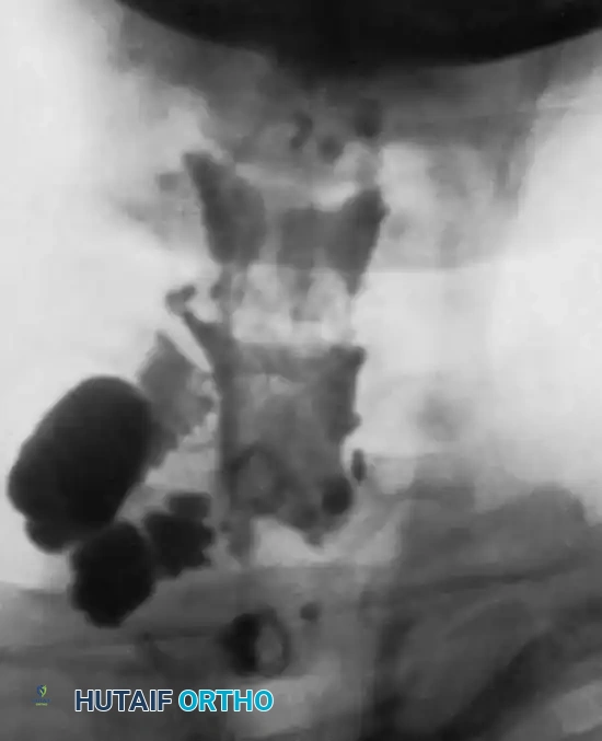 Fig. 59-18 Pantopaque myelogram showing pseudomeningocele produced by avulsion of roots of C7 and C8; C5 and C6, which also were avulsed, did not fi ll. T1 still functions.