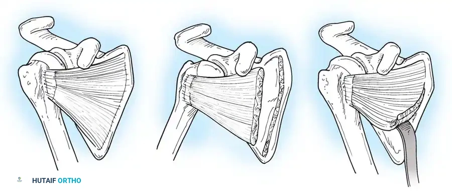BRACHIAL PLEXUS PALSY Surgical Diagram