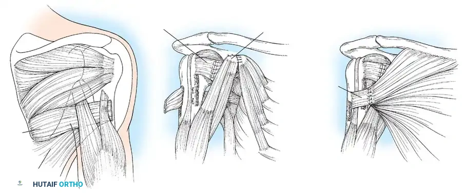 BRACHIAL PLEXUS PALSY Surgical Diagram