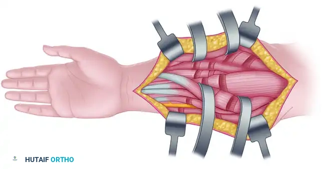 Surgical Management of the Spastic Upper Extremity: Brachioradialis Rerouting and Wrist Flexion Deformities