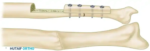 CANCELLOUS INSERT GRAFTS Surgical Diagram