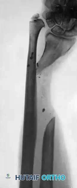 CANCELLOUS INSERT GRAFTS Surgical Diagram