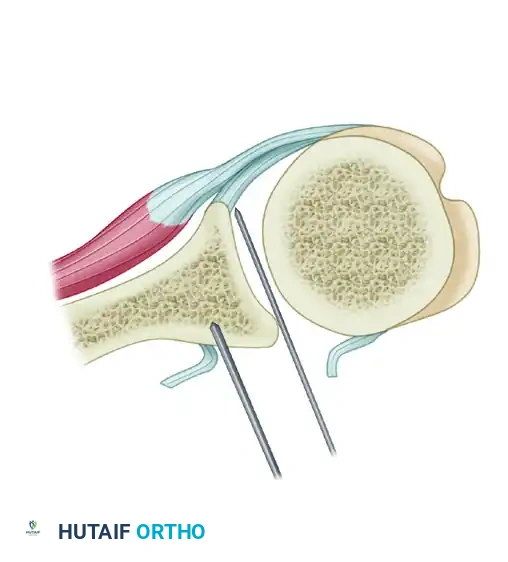 CAPSULAR SHIFT RECONSTRUCTION WITH POSTERIOR GLENOID OSTEOTOMY Surgical Diagram