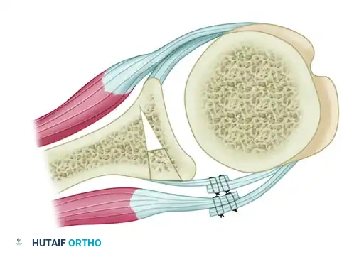 CAPSULAR SHIFT RECONSTRUCTION WITH POSTERIOR GLENOID OSTEOTOMY Surgical Diagram