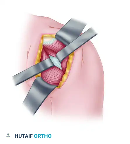 CAPSULAR SHIFT RECONSTRUCTION WITH POSTERIOR GLENOID OSTEOTOMY Surgical Diagram