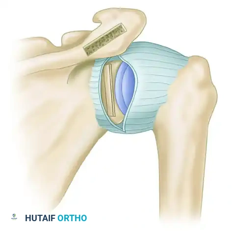 CAPSULAR SHIFT RECONSTRUCTION WITH POSTERIOR GLENOID OSTEOTOMY Surgical Diagram