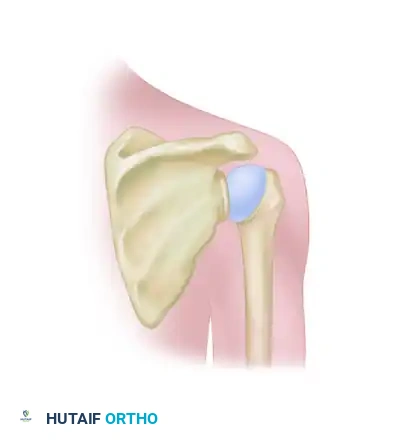 CAPSULAR SHIFT RECONSTRUCTION WITH POSTERIOR GLENOID OSTEOTOMY Surgical Diagram