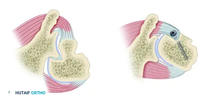 CAPSULAR SHIFT RECONSTRUCTION WITH POSTERIOR GLENOID OSTEOTOMY Surgical Diagram