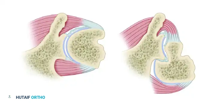 CAPSULAR SHIFT RECONSTRUCTION WITH POSTERIOR GLENOID OSTEOTOMY Surgical Diagram